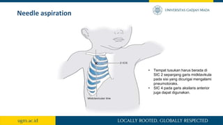 Needle aspiration
• Tempat tusukan harus berada di
SIC 2 sepanjang garis midklavikula
pada sisi yang dicurigai mengalami
pneumotoraks.
• SIC 4 pada garis aksilaris anterior
juga dapat digunakan.
 