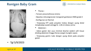 Rontgen Baby Gram
• Tgl 5/9/2023
• Thorax :
- Tension pneumothorax sinistra
- Opasitas reticulogranular mengarah gambaran HMD grade II
- Konfigurasi cor Normal
- Terpasang ETT pada proyeksi trakea dengan ujung distal
menghadap caudal setinggi lk. 1.28 cm diatas carina
• Abdomen :
- Udara gaster dan usus minimal disertai oedem soft tissue
dinding abdomen hingga thorax sangat mungkin sepsis
- Terpasang gastric tube dengan ujung distal pada proyeksi
gaster
 