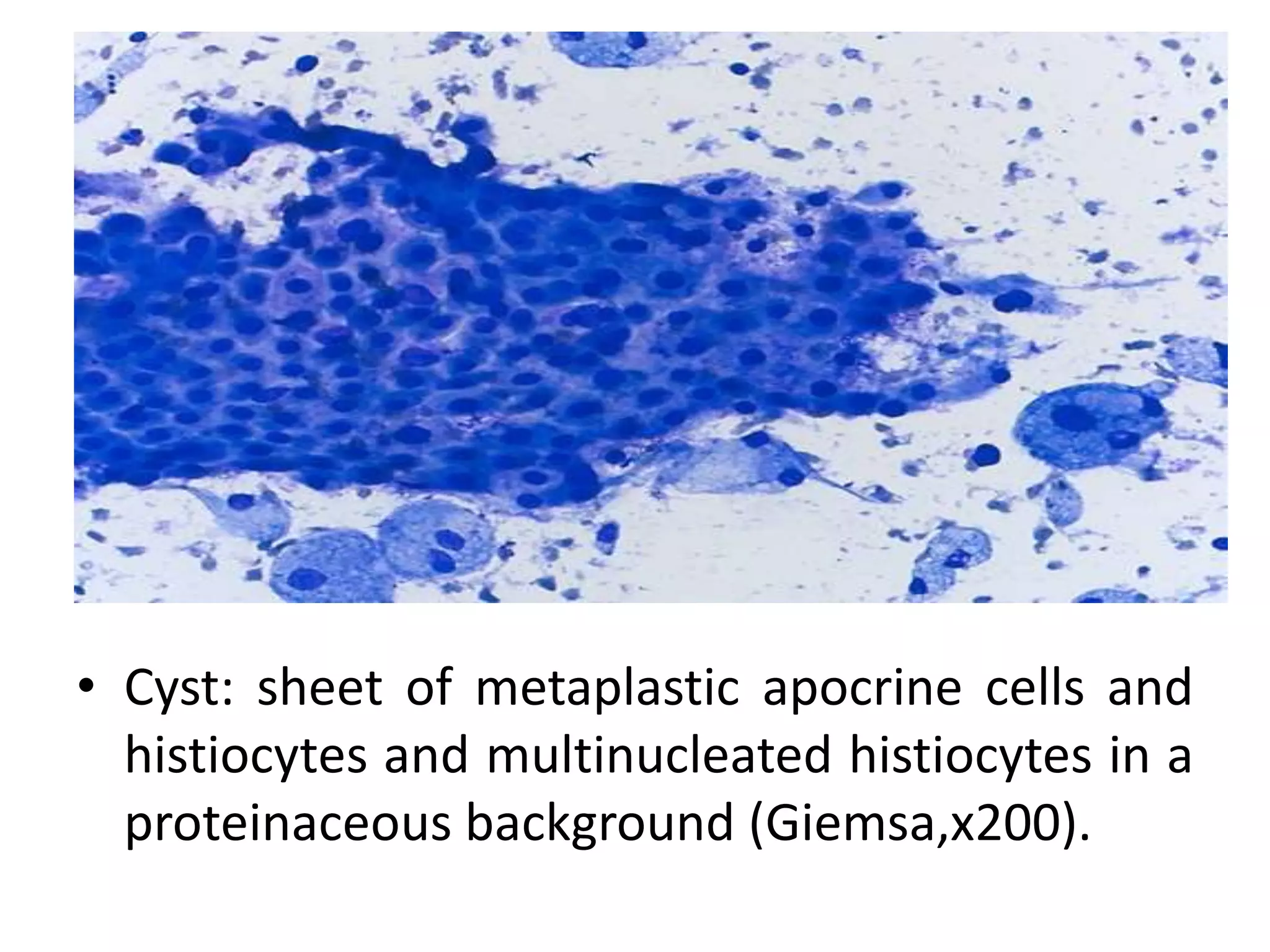 • Cyst: sheet of metaplastic apocrine cells and
histiocytes and multinucleated histiocytes in a
proteinaceous background (Giemsa,x200).
 