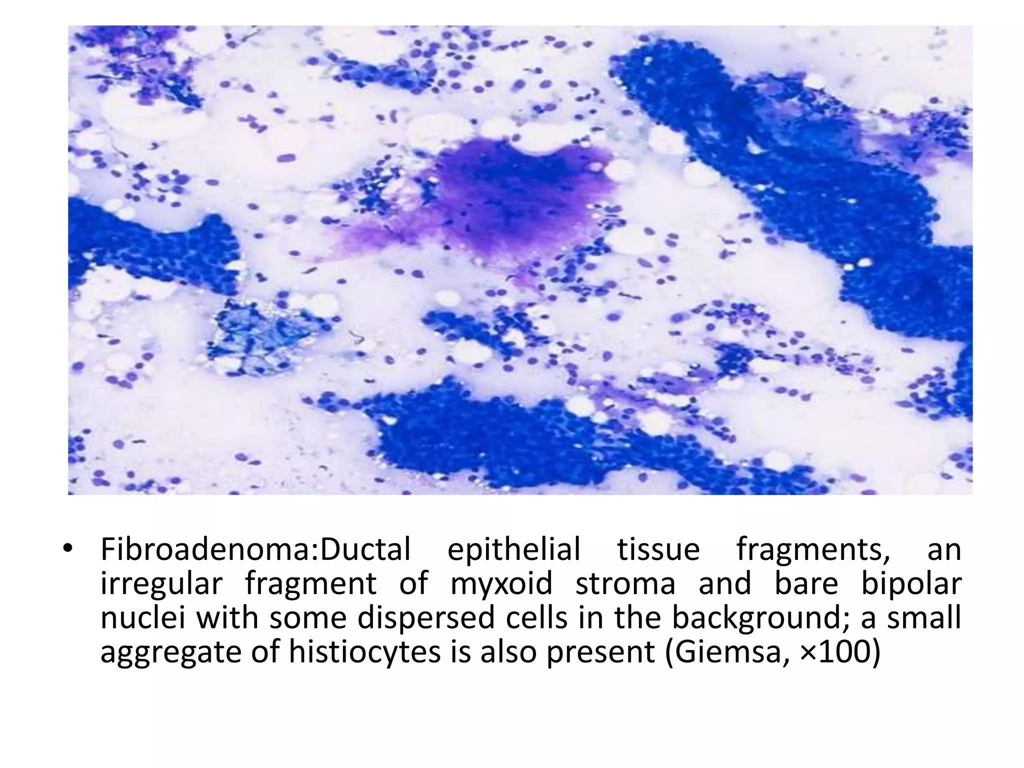 • Fibroadenoma:Ductal epithelial tissue fragments, an
irregular fragment of myxoid stroma and bare bipolar
nuclei with some dispersed cells in the background; a small
aggregate of histiocytes is also present (Giemsa, ×100)
 