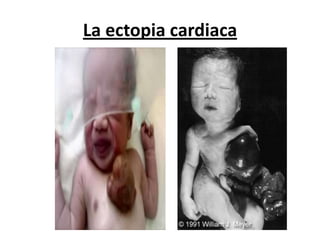 La ectopia cardiaca
 