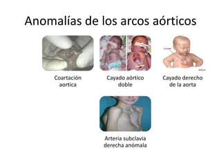 Anomalías de los arcos aórticos



     Coartación    Cayado aórtico     Cayado derecho
      aortica          doble            de la aorta




                  Arteria subclavia
                  derecha anómala
 