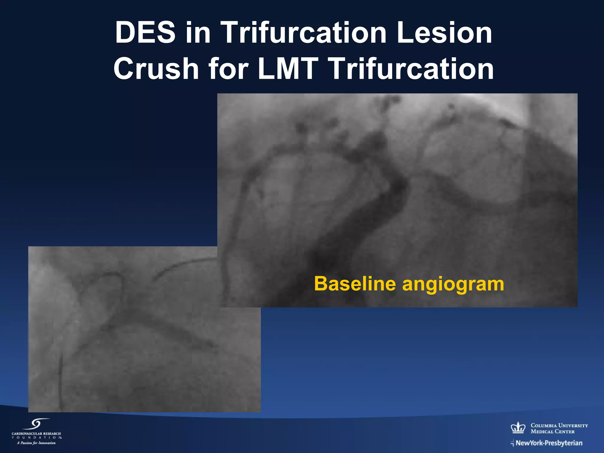 DES in Trifurcation Lesion
Crush for LMT Trifurcation

Baseline angiogram

 