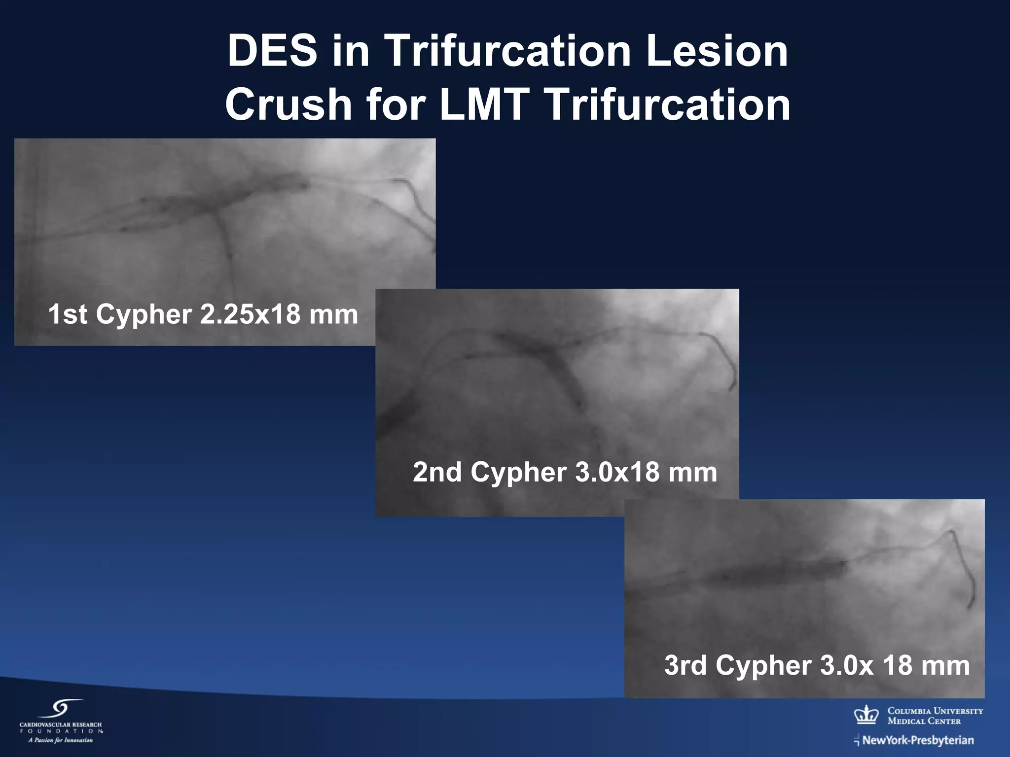 DES in Trifurcation Lesion
Crush for LMT Trifurcation

1st Cypher 2.25x18 mm

2nd Cypher 3.0x18 mm

3rd Cypher 3.0x 18 mm

 