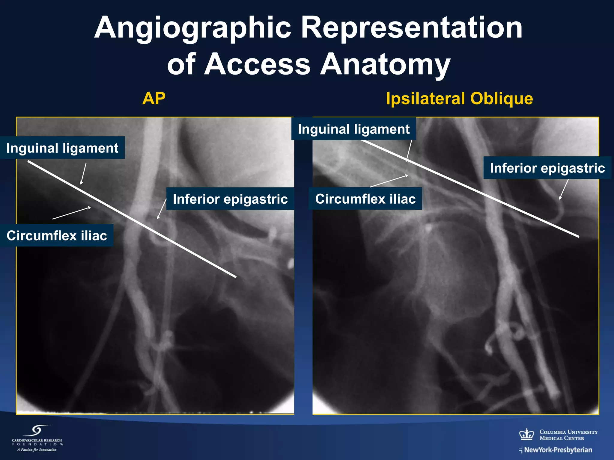 Angiographic Representation
of Access Anatomy
AP

Ipsilateral Oblique
Inguinal ligament

Inguinal ligament
Inferior epigastric
Inferior epigastric
Circumflex iliac

Circumflex iliac

 