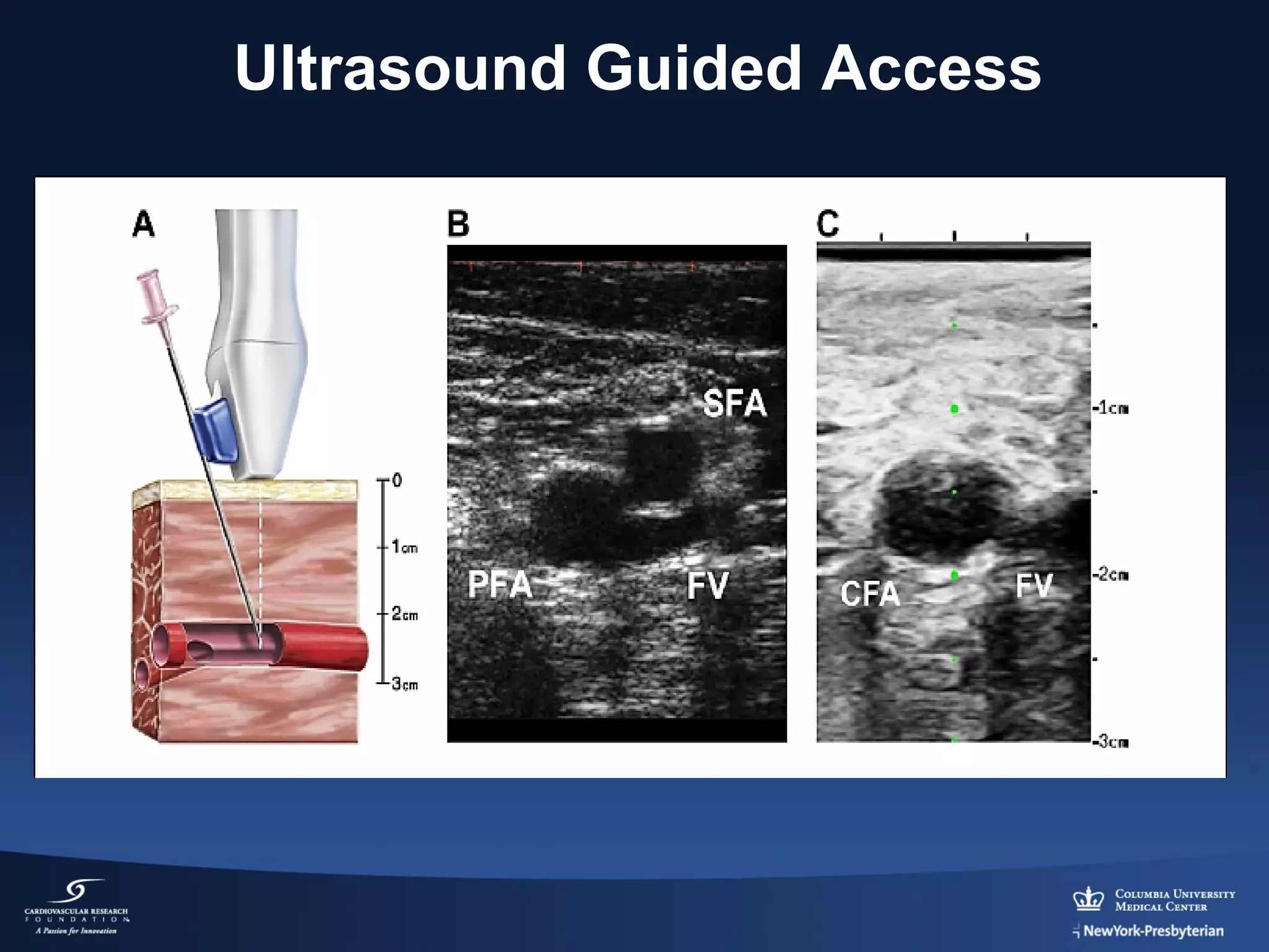 Ultrasound Guided Access

 