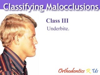 Class III Underbite. 
