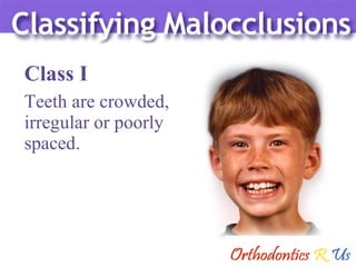 Teeth are crowded,  irregular or poorly spaced. Class I 