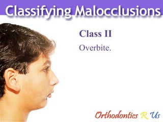 Class II Overbite. 