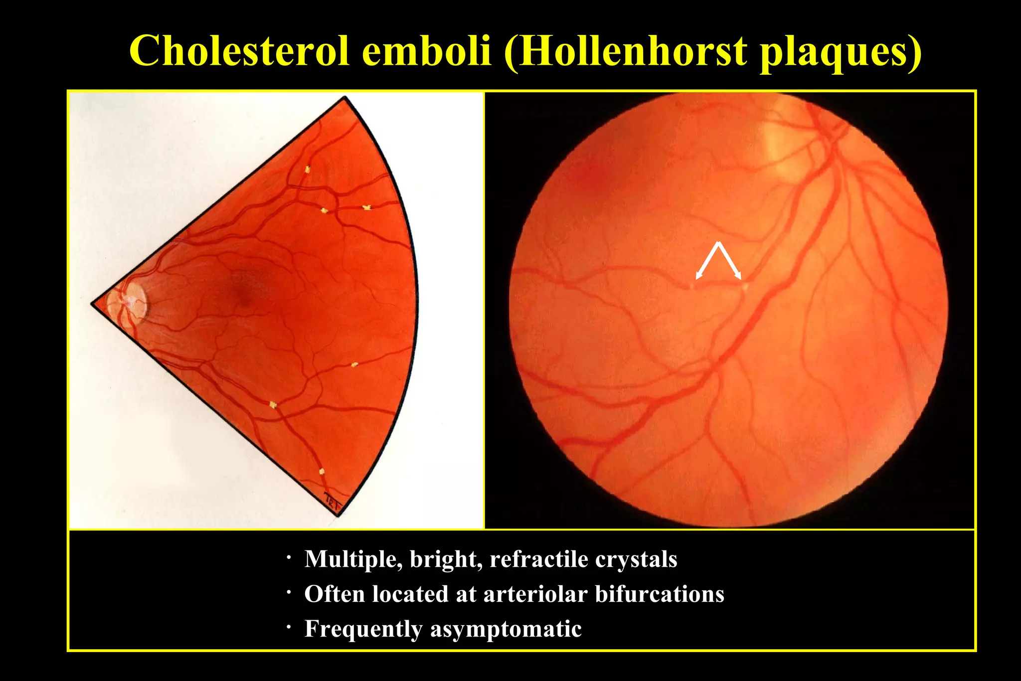Retinal Vascular occlusion | PPT | Eye and Vision Conditions | Diseases ...
