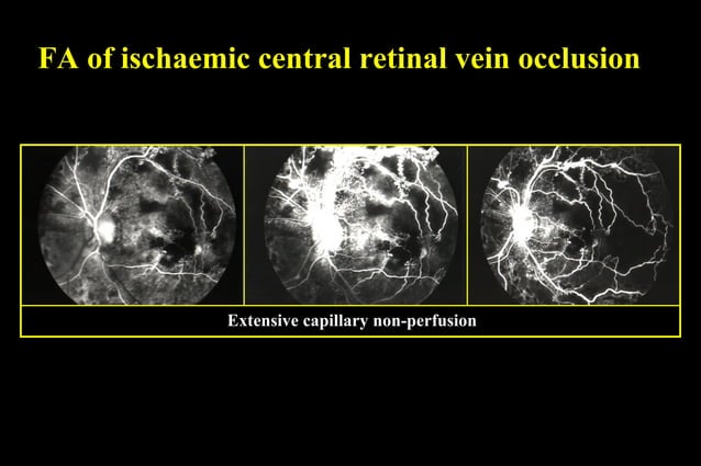 Retinal Vascular occlusion | PPT | Eye and Vision Conditions | Diseases ...
