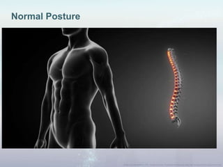 Normal Posture
 