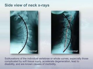 Subluxations of the individual vertebrae or whole curves, especially those
complicated by soft tissue injury, accelerate degeneration, lead to
disability, and are known causes of morbidity.
Side view of neck x-rays
Normal Abnormal
 