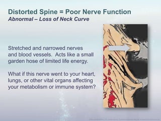 Distorted Spine = Poor Nerve Function
Abnormal – Loss of Neck Curve
Stretched and narrowed nerves
and blood vessels. Acts like a small
garden hose of limited life energy.
What if this nerve went to your heart,
lungs, or other vital organs affecting
your metabolism or immune system?
 