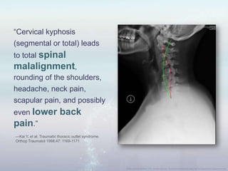 “Cervical kyphosis
(segmental or total) leads
to total spinal
malalignment,
rounding of the shoulders,
headache, neck pain,
scapular pain, and possibly
even lower back
pain.”
—Kai Y, et al. Traumatic thoracic outlet syndrome.
Orthop Traumatol 1998;47: 1169-1171
 