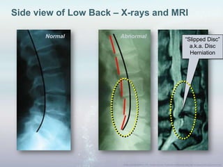 “Slipped Disc”
a.k.a. Disc
Herniation
Side view of Low Back – X-rays and MRI
AbnormalNormal
 