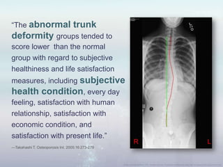 “The abnormal trunk
deformity groups tended to
score lower than the normal
group with regard to subjective
healthiness and life satisfaction
measures, including subjective
health condition, every day
feeling, satisfaction with human
relationship, satisfaction with
economic condition, and
satisfaction with present life.”
—Takahashi T. Osteoporosis Int. 2005:16 273-279
 