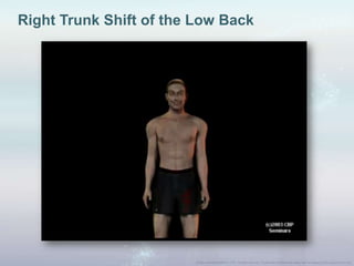 Right Trunk Shift of the Low Back
 