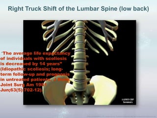 Right Truck Shift of the Lumbar Spine (low back)
“The average life expectancy
of individuals with scoliosis
is decreased by 14 years”
(Idiopathic scoliosis; long-
term follow-up and prognosis
in untreated patients, J Bone
Joint Surg Am 1981
Jun;63(5):702-12).
 