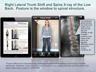 "Posture affects and moderates every physiologic function from breathing to hormonal production.
Spinal pain, headache, mood, blood pressure, pulse and lung capacity are among the functions most
easily influenced by posture.“ AJPM 1994
Right Lateral Trunk Shift and Spine X-ray of the Low
Back. Posture is the window to spinal structure.
This weakened
spinal structure
may lead to disc
bulges, nerve
injury into the
legs and
disability, as well
as health
problems in the
organs of the
pelvis, like
digestive
difficulties, sexual
dysfunction,
urinary
conditions, etc.
 