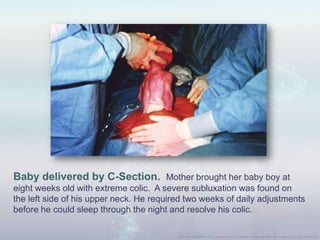 Baby delivered by C-Section. Mother brought her baby boy at
eight weeks old with extreme colic. A severe subluxation was found on
the left side of his upper neck. He required two weeks of daily adjustments
before he could sleep through the night and resolve his colic.
 