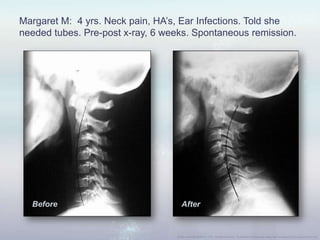 Margaret M: 4 yrs. Neck pain, HA‟s, Ear Infections. Told she
needed tubes. Pre-post x-ray, 6 weeks. Spontaneous remission.
AfterBefore
 