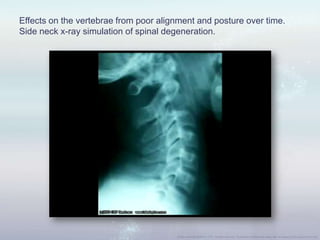 Effects on the vertebrae from poor alignment and posture over time.
Side neck x-ray simulation of spinal degeneration.
 