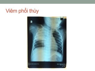 Viêm phổi thùy
 