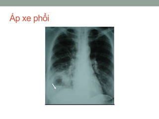 Áp xe phổi
 