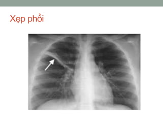 Xẹp phổi
 