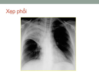 Xẹp phổi
 