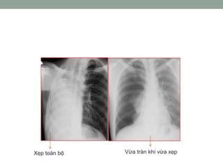 Xẹp toàn bộ Vừa tràn khí vừa xẹp
 