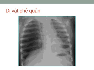 Dị vật phế quản
 