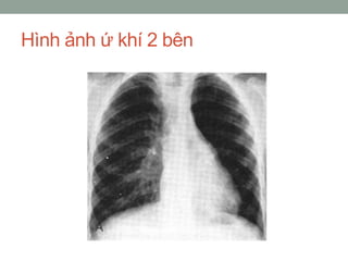 Hình ảnh ứ khí 2 bên
 