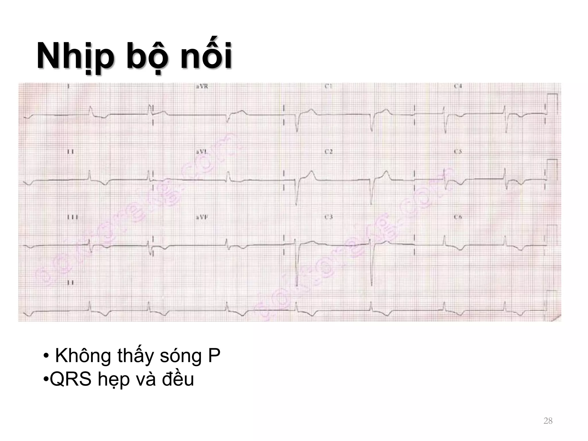 CÁC BƯỚC ĐỌC ECG | PDF