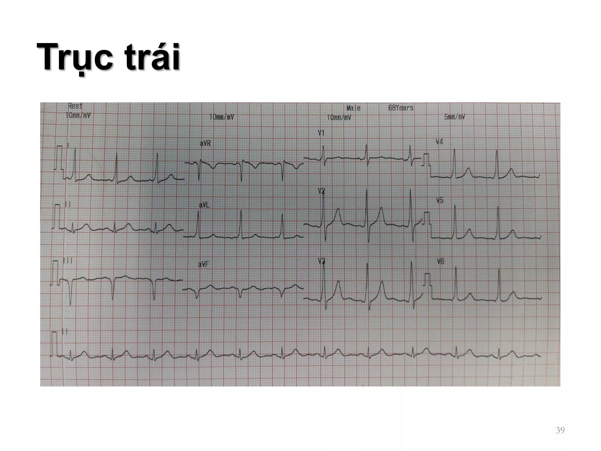 CÁC BƯỚC ĐỌC ECG | PDF