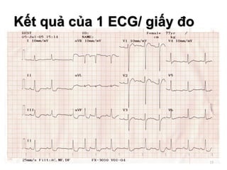 15
Kết quả của 1 ECG/ giấy đo
 