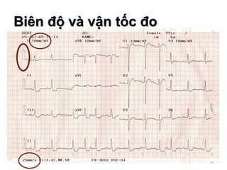 18
Biên độ và vận tốc đo
 