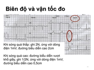 Biên độ và vận tốc đo
19
Khi sóng quá thấp: ghi 2N, ứng với dòng
điện 1mV, đường biểu diễn cao 2cm
Khi sóng quá cao: đường biểu diễn vượt
khổ giấy, ghi 1/2N, ứng với dòng điện 1mV,
đường biểu diễn cao 0,5cm
 