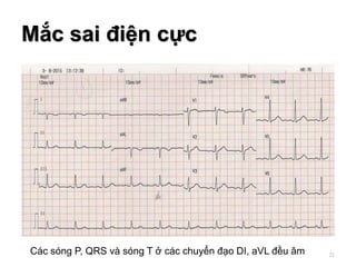Mắc sai điện cực
21Các sóng P, QRS và sóng T ở các chuyển đạo DI, aVL đều âm
 