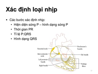Xác định loại nhịp
 Các bước xác định nhịp:
• Hiện diện sóng P – hình dạng sóng P
• Thời gian PR
• Tỉ lệ P:QRS
• Hình dạng QRS
22
 