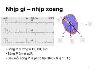 Nhịp gì – nhịp xoang
• Sóng P dương ở DI, DII, aVF
• Sóng P âm ở avR
• Sau mỗi sóng P là phức bộ QRS ( tỉ lệ 1 : 1 )
24
 
