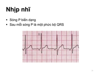 Nhịp nhĩ
 Sóng P biến dạng
 Sau mỗi sóng P là một phức bộ QRS
25
 