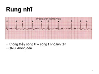 Rung nhĩ
• Không thấy sóng P – sóng f nhỏ lăn tăn
• QRS không đều
26
 