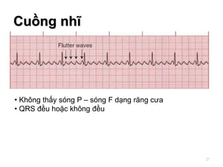 Cuồng nhĩ
• Không thấy sóng P – sóng F dạng răng cưa
• QRS đều hoặc không đều
27
 
