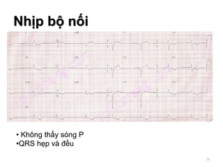 Nhịp bộ nối
• Không thấy sóng P
•QRS hẹp và đều
28
 