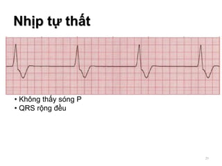 Nhịp tự thất
• Không thấy sóng P
• QRS rộng đều
29
 