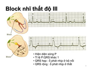 Block nhĩ thất độ III
• Hiện diện sóng P
• Tỉ lệ P:QRS khác 1
• QRS hẹp : ổ phát nhịp ở bộ nối
• QRS rộng : ổ phát nhịp ở thất 30
 