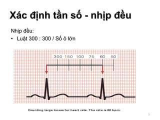 Nhịp đều:
• Luật 300 : 300 / Số ô lớn
Xác định tần số - nhịp đều
31
 