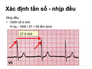 Nhịp đều:
• 1500/ số ô nhỏ
Ví dụ : 1500 / 27 = 55 lần/ phút
27 ô nhỏ
Xác định tần số - nhịp đều
32
 